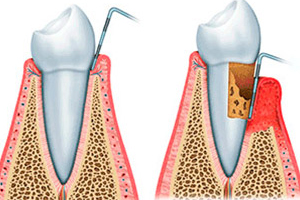 An illustration that shows gum disease. The left illustration shows a healthy tooth but when you look at the inside, it actually has gum disease as shown on the right