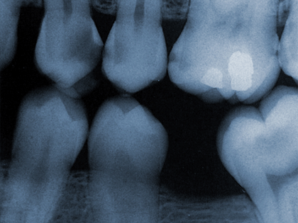 Am x-ray result that show teeth and a missing tooth on the lower jaw