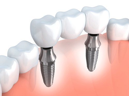An illustration that shows a dental bridge in between two teeth implants
