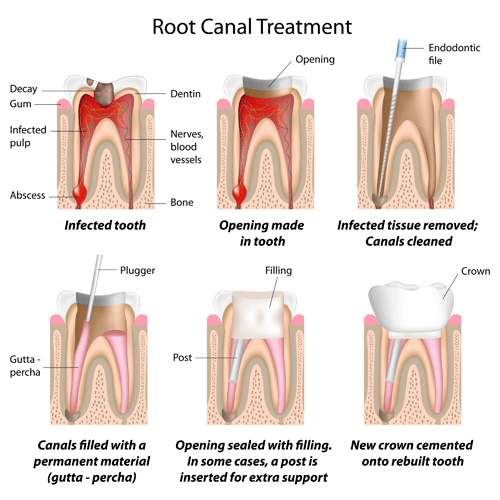 A step by step illustration of a root canal treatment