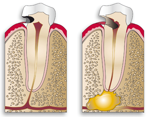 A comparison of two tooth with (right) and without (left) a cavity