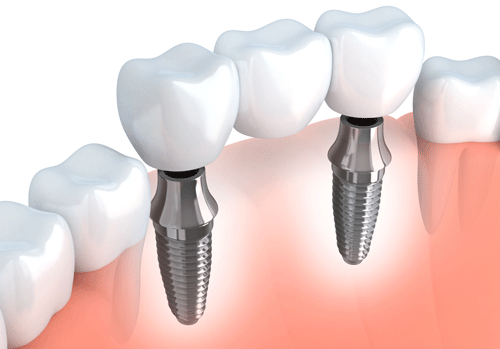 A set of teeth focusing on the two teeth implants and in between them is a healthy tooth