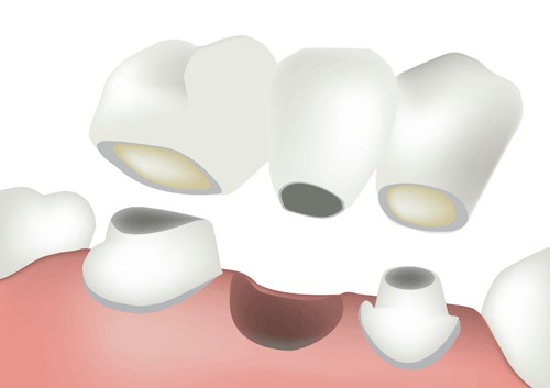 Teeth cut in half horizontally to show a fixed dental bridge with root canal