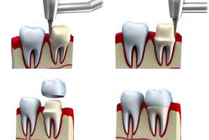 A step by step illustration of tooth extaction and repair