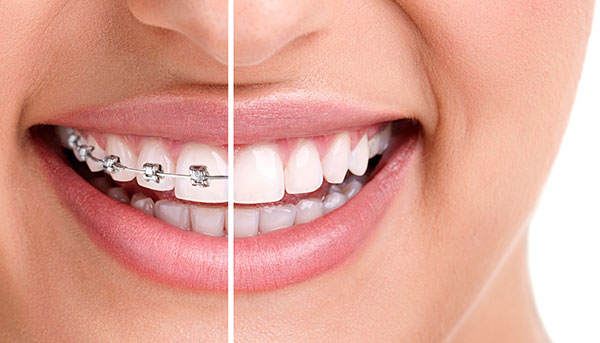 A woman smiling and there's a line in between comparing teeth during and after fastbraces