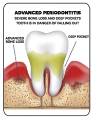 An illustration that shows Advanced Periodontitis - with advanced bone loss and deep pocket
