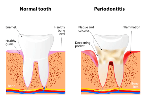 An illustration that shows Periodontitis: left - a normal tooth, right - an inflamed gum, tooth with plaque and deepening pockets
