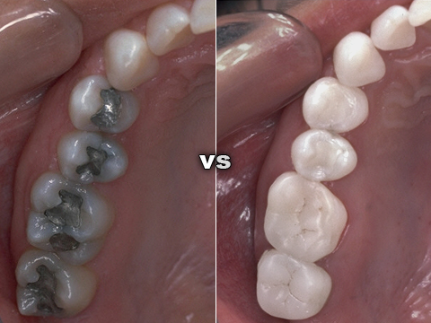 Photos of during (left) and after (right) a full arch implant
