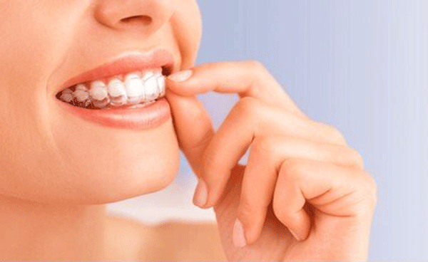 La Puente Family Dental Center Now Offering Invisalign Teeth Straightening System