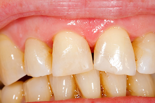 Invisalign treats common tooth alignment