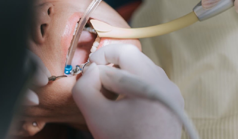 Root Canals: What You Need to Know