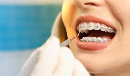 A woman with braces on dental clinic