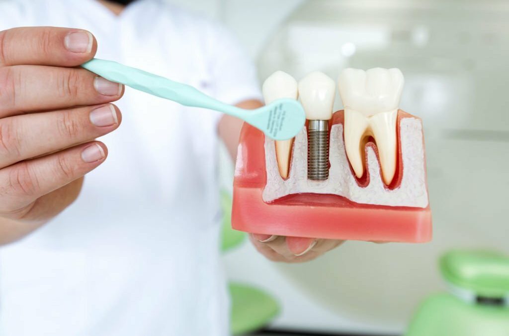 Finding A Dental Implant Dentist Near You (What You Need To Know)