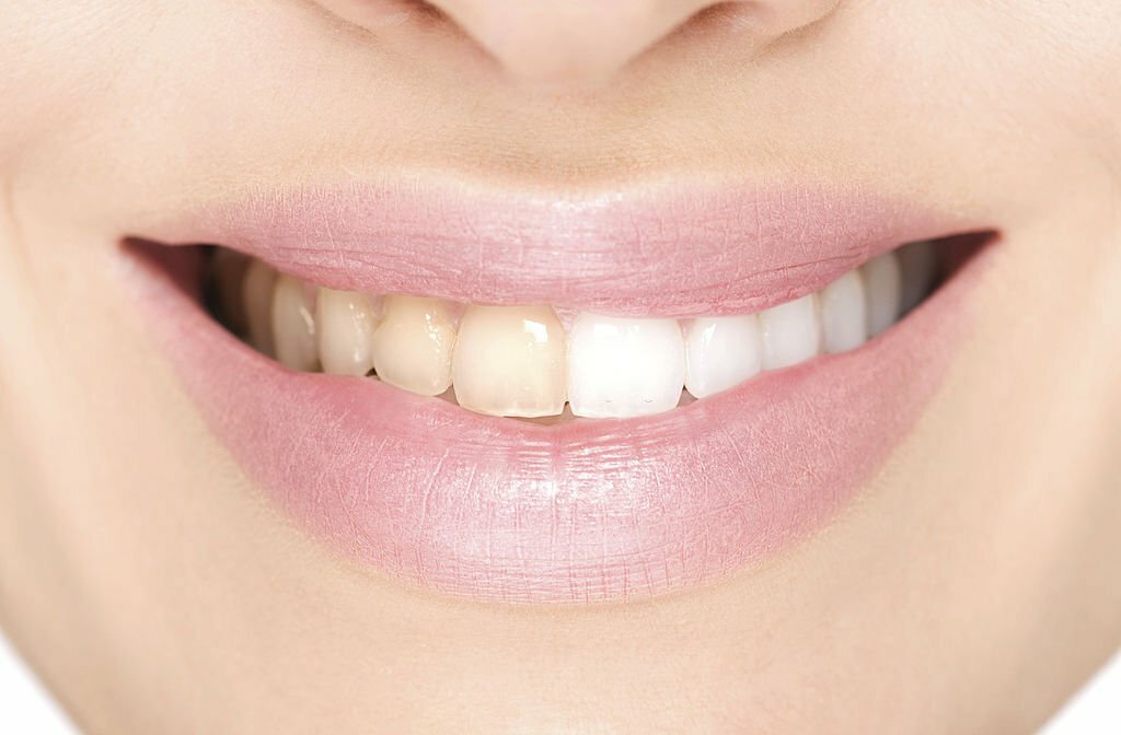 Teeth Whitening: At Home Or At The Dentist Office?