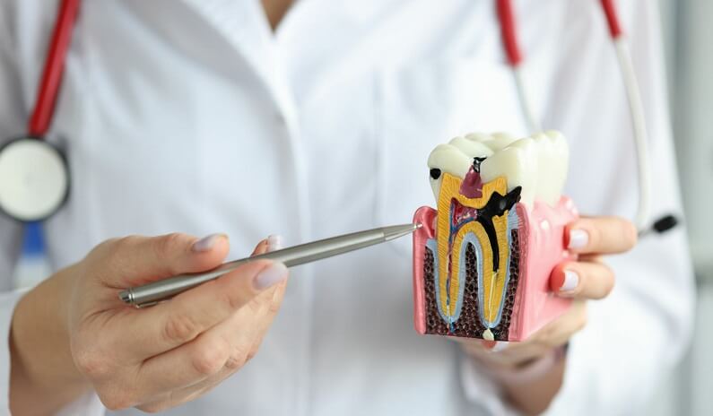 How to Avoid Cavities and Other Dental Problems